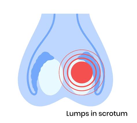 pea sized lump on testicle